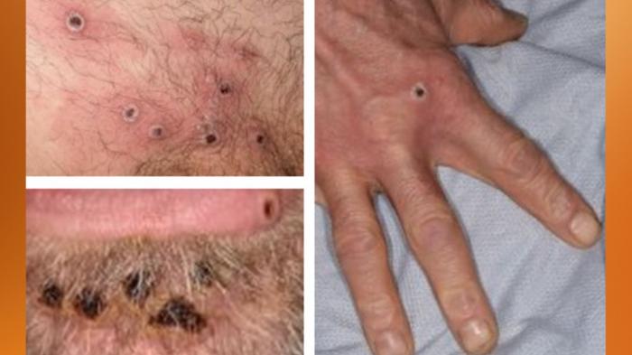 STG Mpox: Fifth UK Case detected in Leeds - what are the symptoms and how is an infected person treated?